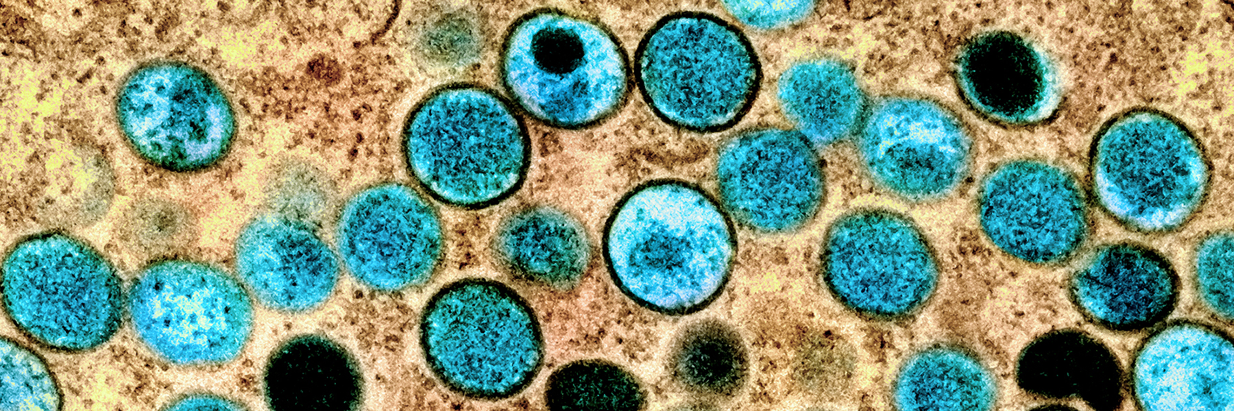Colorized transmission electron micrograph of monkeypox particles (teal) found within an infected cell (brown), cultured in the laboratory. Image captured and color-enhanced at the NIAID Integrated Research Facility (IRF) in Fort Detrick, Maryland. Credit: NIAID