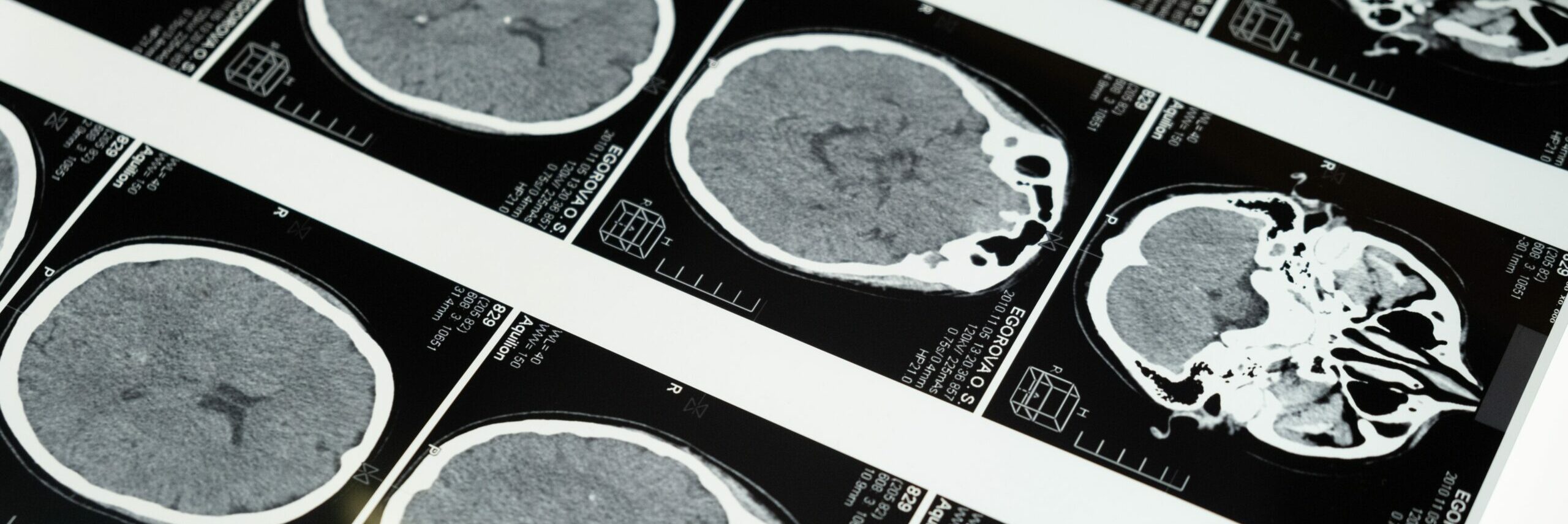 Brain scan MRI